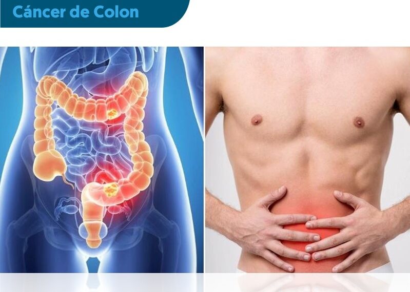 Día Mundial Contra El Cáncer De Colon